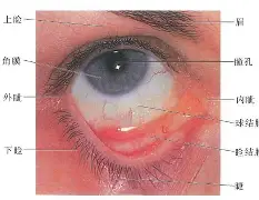 kaiyun-疤痕眼睑退缩图片大全